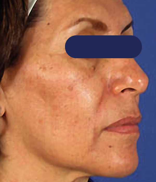 Piel con arrugas, manchas y cicatrices antes del tratamiento con Edge ONE.