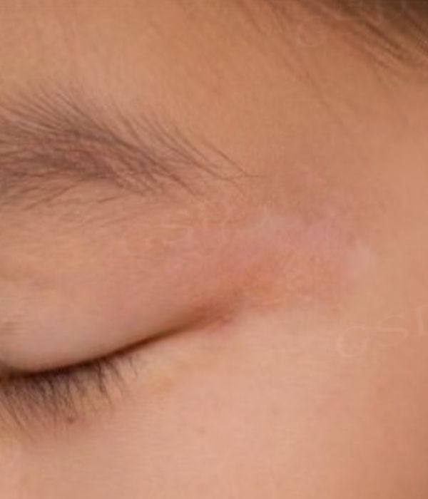 Imagen clínica antes del tratamiento con Eximal Mini, mostrando placas despigmentadas por vitiligo