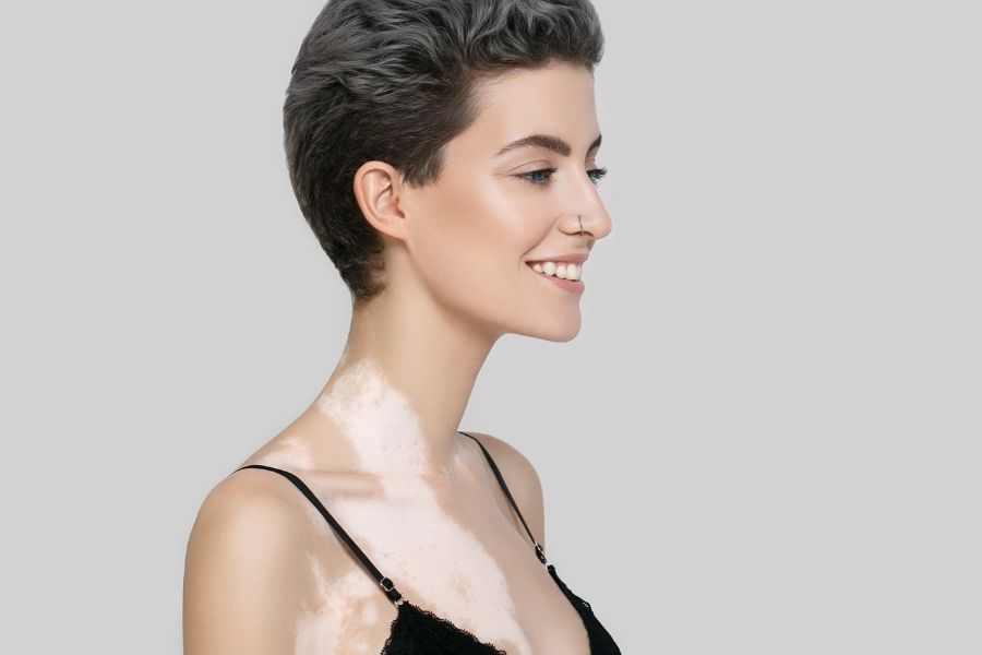 Modelo de tratamiento dermatológico con luz excimer 308 nm equipo Eximal Mini