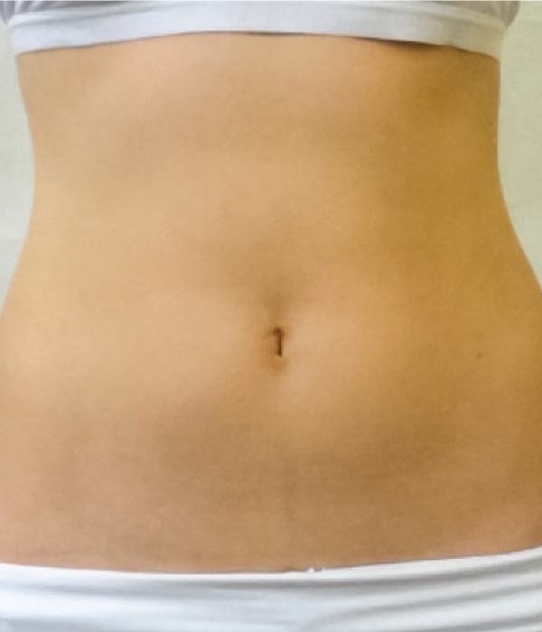 Comparativa clínica después del tratamiento con PowerShape2, piel firme y superficie homogénea