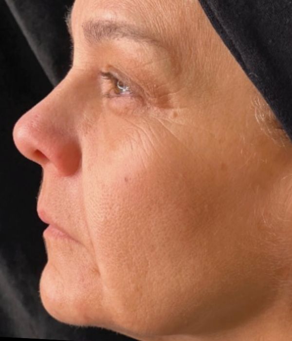 Comparativa de tratamiento antes de usar Olidia Ácido Poliláctico, pérdida de volumen facial y flacidez cutánea.