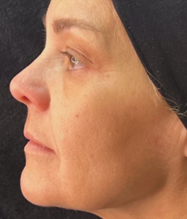 Resultados posteriores al tratamiento con Olidia, aumento de densidad dérmica y mejora en la definición facial.