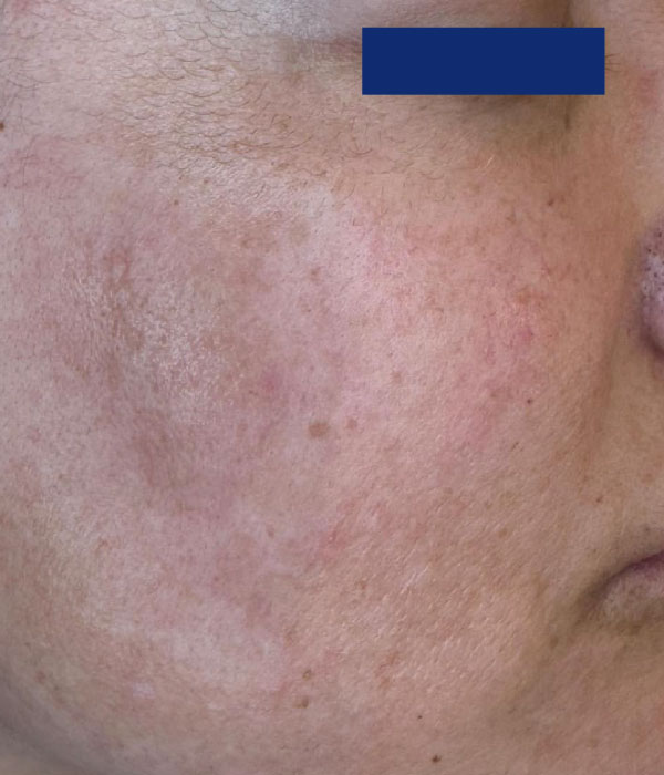 Comparativa clínica antes del tratamiento con Renvix, mostrando signos visibles de envejecimiento y debilitamiento capilar