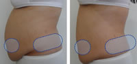 Tratamiento en abdomen y espalda baja con COOLshaping