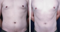 Tratamiento en abdomen con CoreSculpt