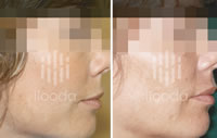 Tratamiento en Reducción de la textura de la piel y de las arrugas con Secret RF