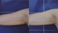 Tratamiento en parte superior del brazo con ULTRAcel Q+