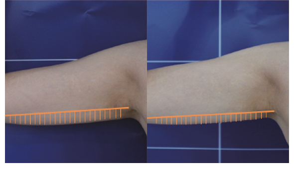 Antes y despúes de tratamiento en la parte superior del brazo con ULTRAcel Q+